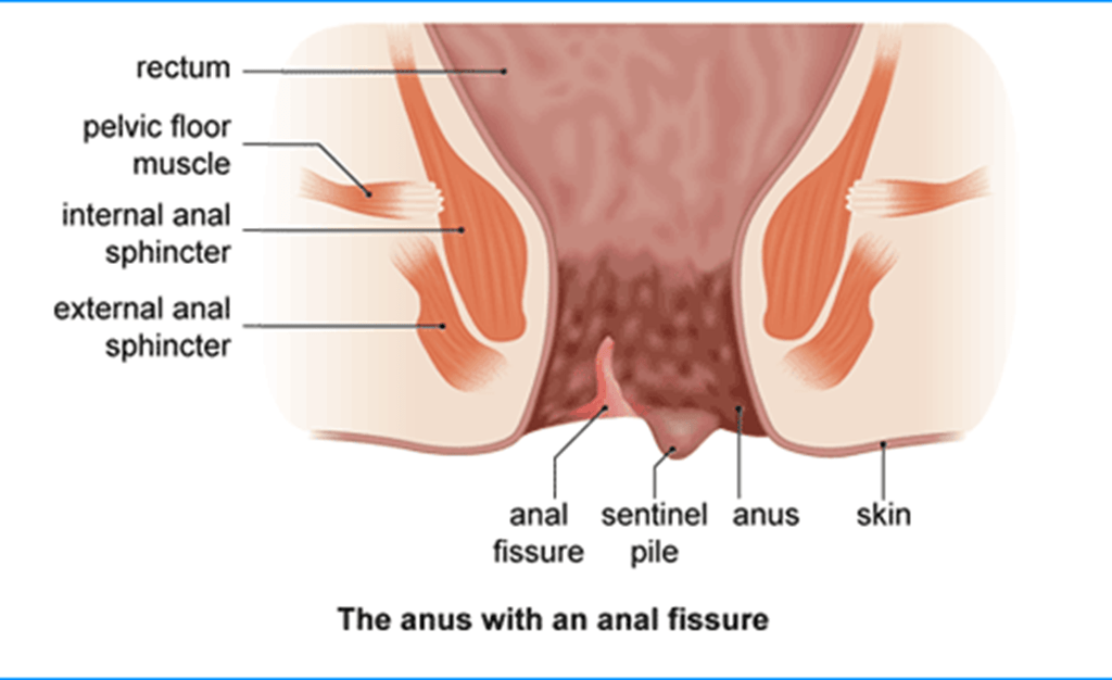 Anal Fissure Treatment