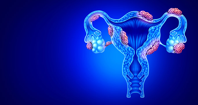 Uterine Fibroids Image 2