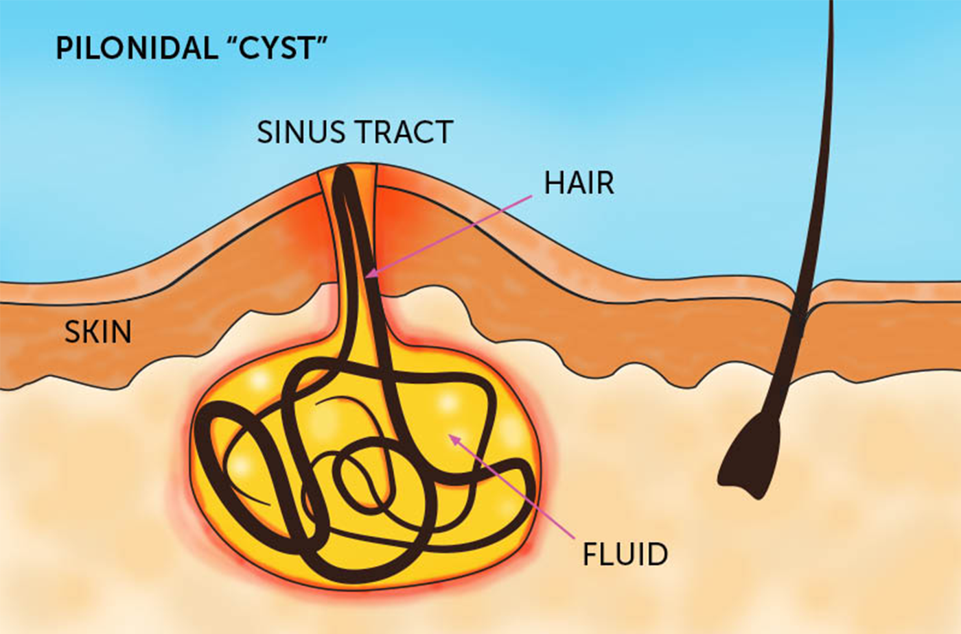 Pilonidal Sinus Treatment