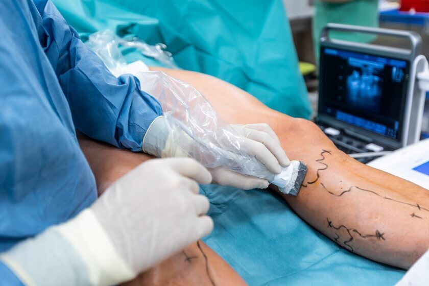 Laser Treatment for Varicose Veins
